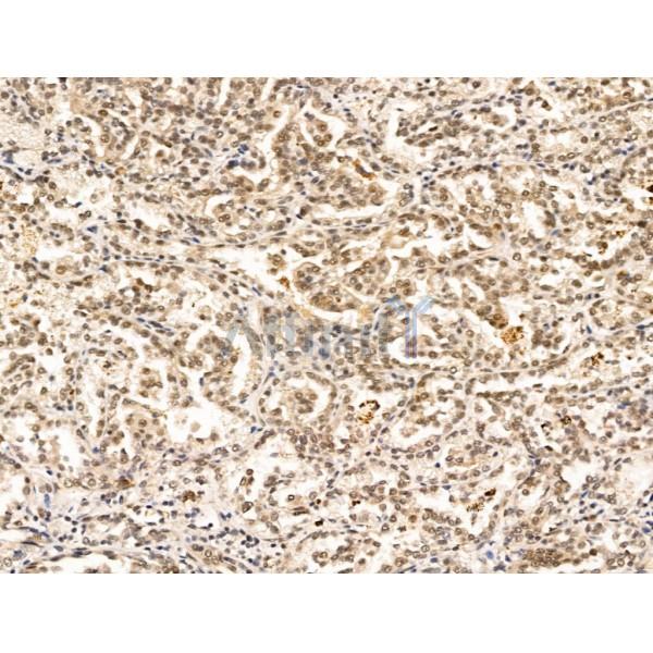 SEPT4 Antibody - DF13393 at 1/100 staining Human kidney cancer by IHC-P.