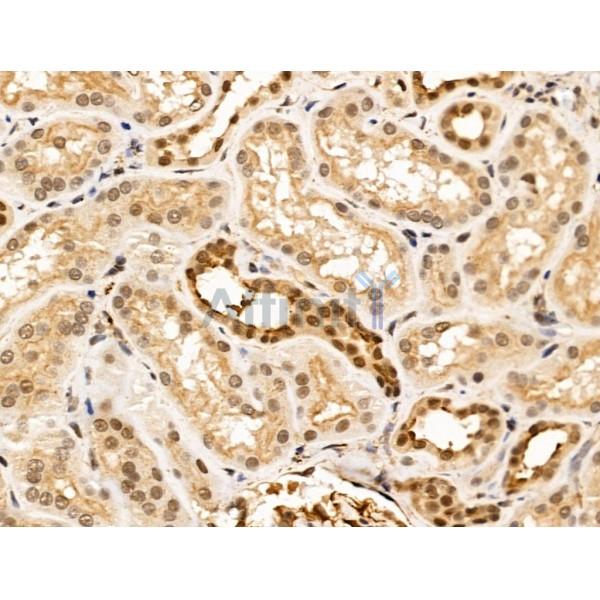 SEPT4 Antibody - DF13393 at 1/100 staining Human kidney cancer and adjacent normal tissues by IHC-P.