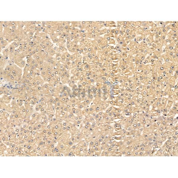 Surfactant Protein A Antibody - DF13404 at 1/100 staining Human liver cancer by IHC-P.