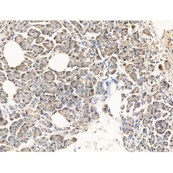 Surfactant Protein A Antibody - DF13404 at 1/100 staining Human pancreatic cancer and adjacent nomal tissues by IHC-P.
