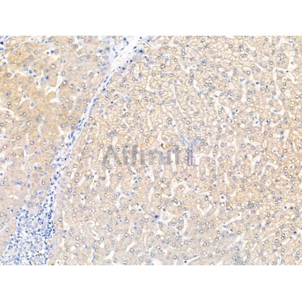 KCNK5 Antibody - DF13412 at 1/100 staining Human liver cancer and adjacent normal tissues by IHC-P.