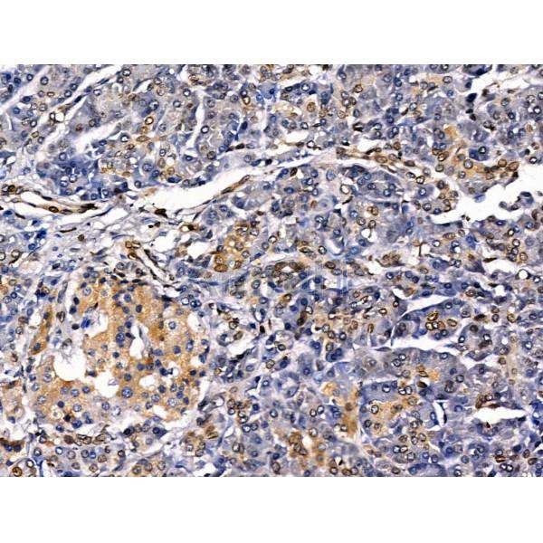 MUM1 Antibody - DF13418 at 1/100 staining Human pancreatic cancer and adjacent nomal tissues by IHC-P.