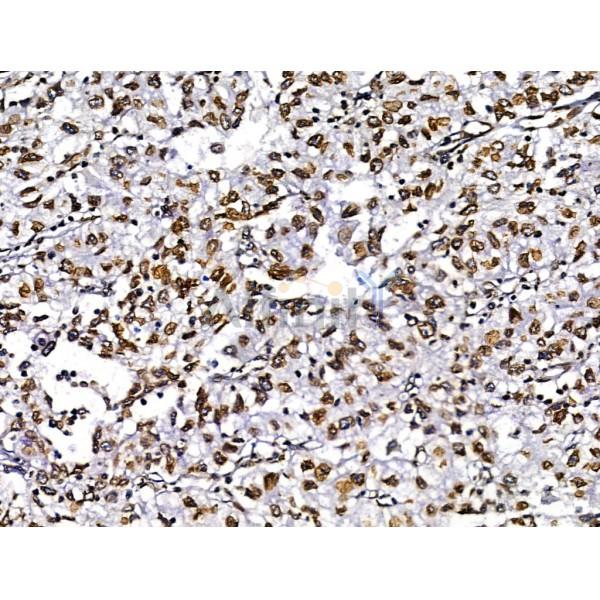 MUM1 Antibody - DF13418 at 1/100 staining Human pancreatic cancer by IHC-P.