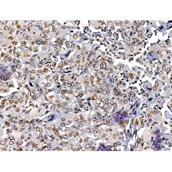 MUM1 Antibody - DF13418 at 1/100 staining Human lung cancer by IHC-P.