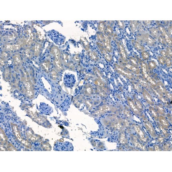 Polycystin 1 Antibody - DF13419 at 1/100 staining Human kidney cancer and adjacent normal tissues by IHC-P.