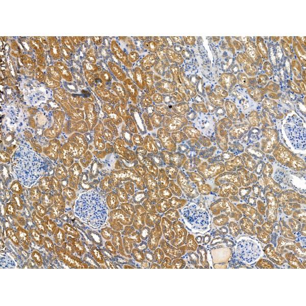 Frizzled 4 Antibody - DF13439 at 1/100 staining Human kidney cancer and adjacent normal tissues by IHC-P.