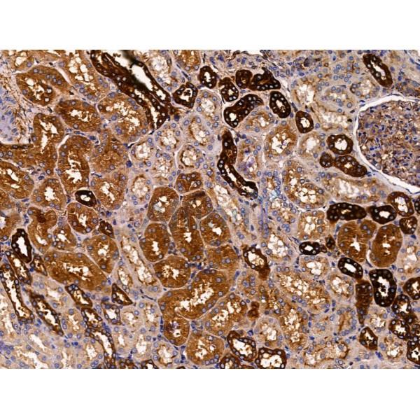 T Plastin Antibody - DF13459 at 1/100 staining Human kidney cancer and adjacent normal tissues by IHC-P.
