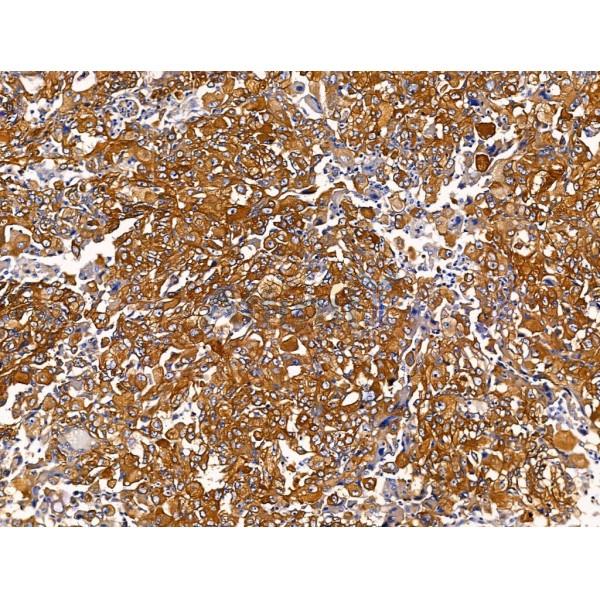 T Plastin Antibody - DF13459 at 1/100 staining Human lung cancer by IHC-P.