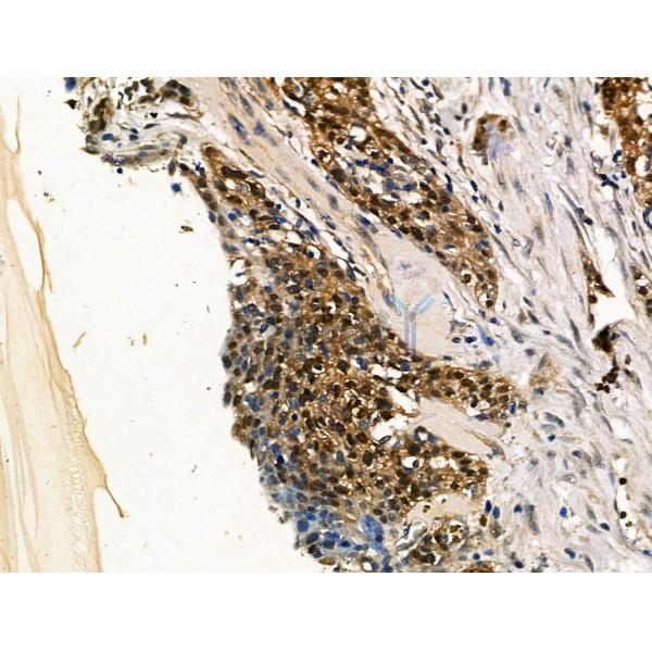 Apc7 Antibody - DF13464 at 1/100 staining Human ovarian cancer by IHC-P.