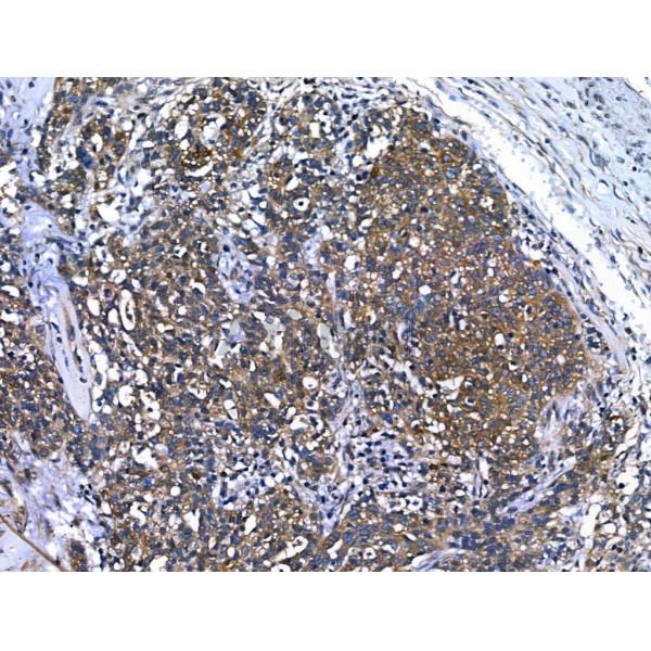 BIRC6 Antibody - DF13472 at 1/100 staining Human ovarian cancer by IHC-P.