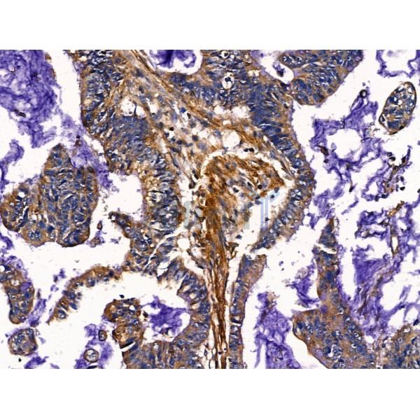 SLIRP Antibody - DF13485 at 1/100 staining Human colorectal cancer by IHC-P.