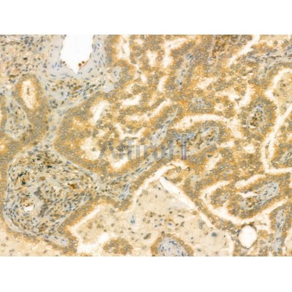 RAB3GAP2 Antibody - DF4372 at 1/100 staining Human lung cancer by IHC-P.