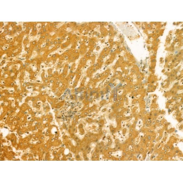 RAB3GAP2 Antibody - DF4372 at 1/100 staining Human pancreatic cancer by IHC-P.