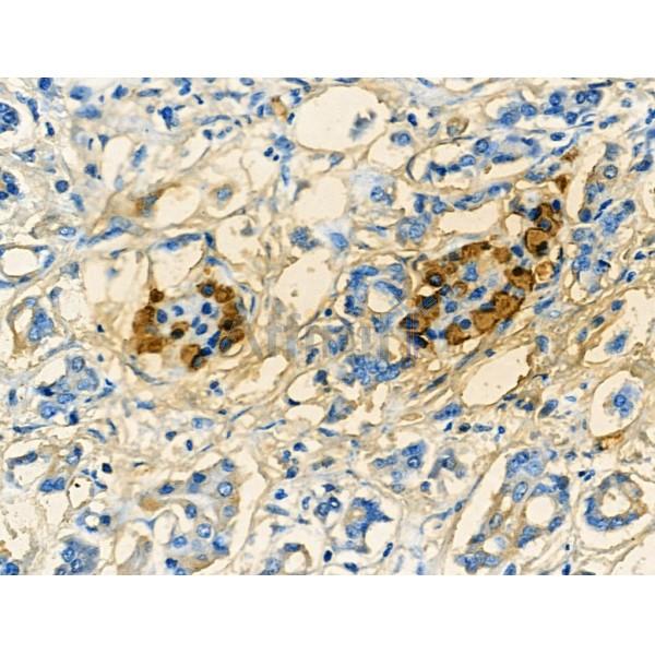 Glucagon Antibody - AF0166 at 1/100 staining Human pancreatic cancer by IHC-P.