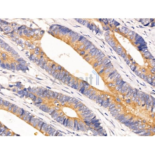 pan-AKT1/2/3 Antibody - AF0791 at 1/100 staining Human colorectal cancer by IHC-P.