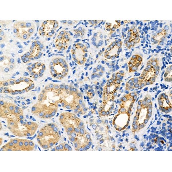 Phospho-STUB1/CHIP (Ser19) Antibody - AF3514 at 1/100 staining Human kidney cancer and adjacent normal tissues by IHC-P.