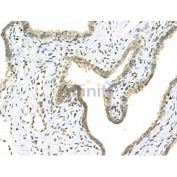 Phospho-TMS1/ASC (Ser195) Antibody - AF3515 at 1/100 staining Human ovarian cancer and adjacent normal tissues by IHC-P.