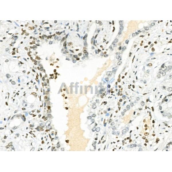 Phospho-TMS1/ASC (Ser195) Antibody - AF3515 at 1/100 staining Human prostate cancer by IHC-P.