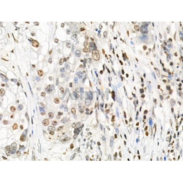 Phospho-TMS1/ASC (Ser195) Antibody - AF3515 at 1/100 staining Human ovarian cancer by IHC-P.