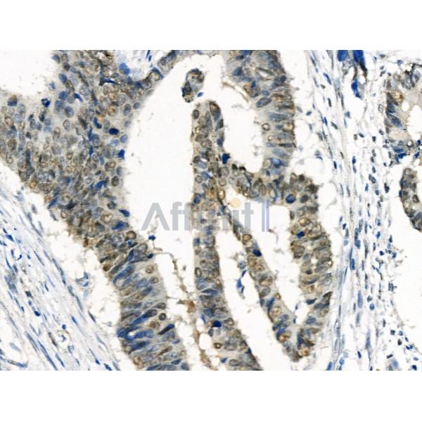 Phospho-RAD18 (Ser99) Antibody - AF3529 at 1/100 staining Human colorectal cancer by IHC-P.