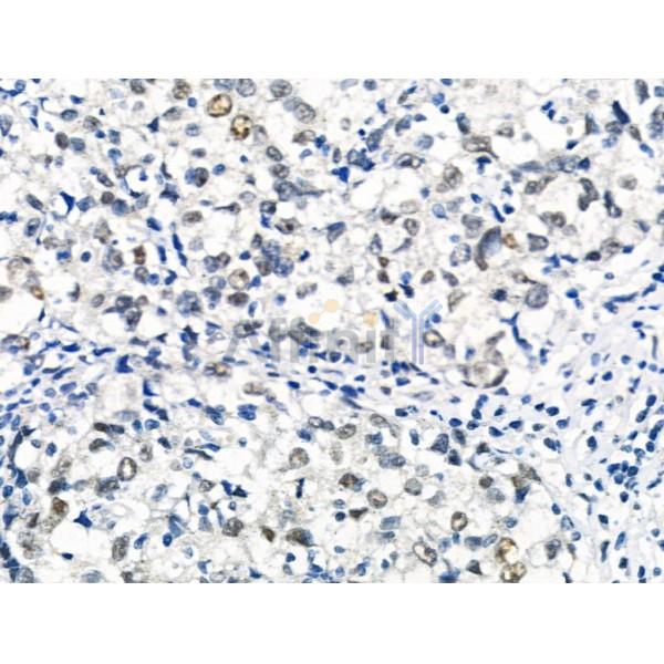 Phospho-RAD18 (Ser99) Antibody - AF3529 at 1/100 staining Human mammary cancer by IHC-P.