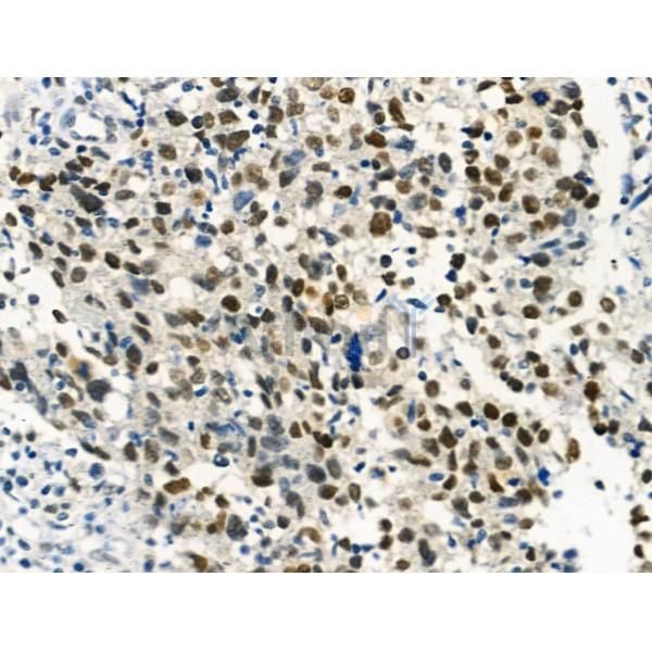 Phospho-RAD18 (Ser99) Antibody - AF3529 at 1/100 staining Human mammary cancer by IHC-P.