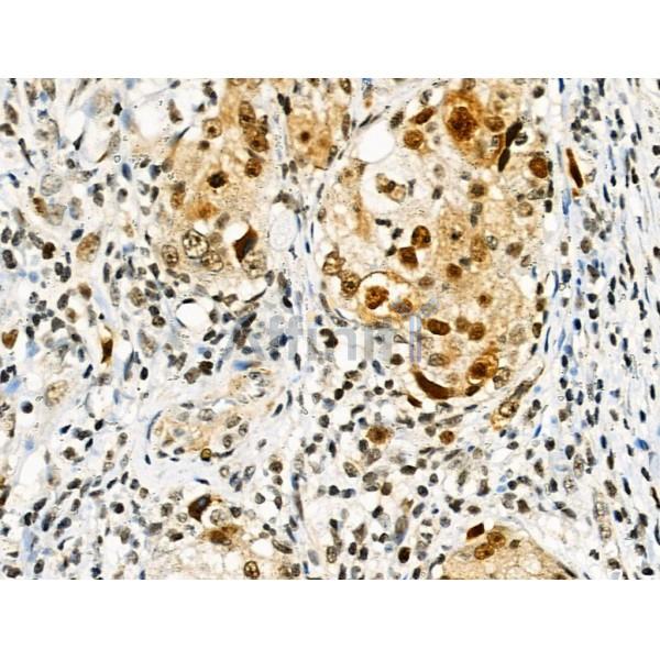 Phospho-RAD18 (Ser471) Antibody - AF3530 at 1/100 staining Human ovarian cancer by IHC-P.