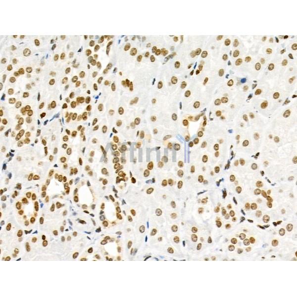 Phospho-SRPK2 (Thr492) Antibody - AF3632 at 1/100 staining Human kidney cancer and adjacent normal tissues by IHC-P.