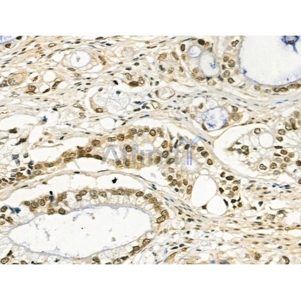 Phospho-SRPK2 (Ser494/Ser497) Antibody - AF3633 at 1/100 staining Human gastric cancer by IHC-P.