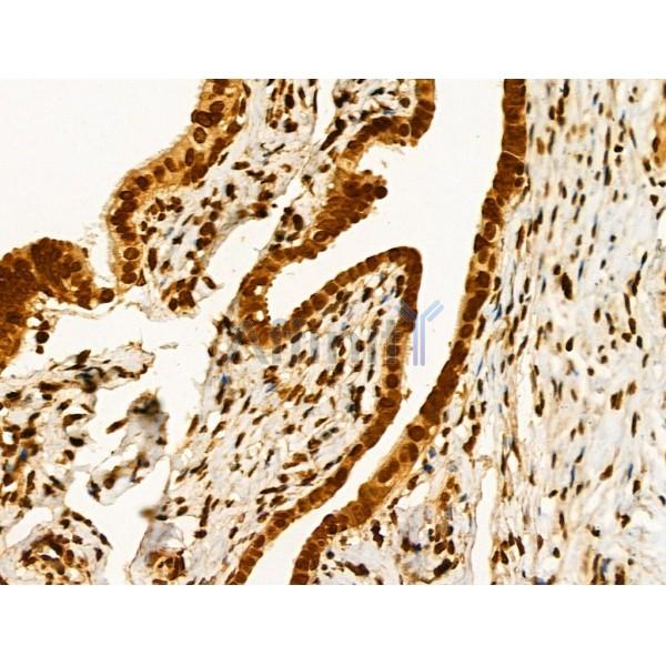Phospho-SRPK2 (Ser494/Ser497) Antibody - AF3633 at 1/100 staining Human ovarian cancer and adjacent normal tissues by IHC-P.