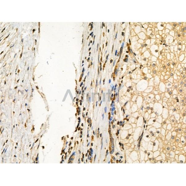 Phospho-SRPK2 (Ser494/Ser497) Antibody - AF3633 at 1/100 staining Human kidney cancer by IHC-P.