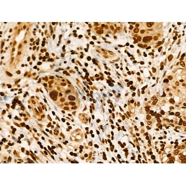 Phospho-SRPK2 (Ser494/Ser497) Antibody - AF3633 at 1/100 staining Human ovarian cancer by IHC-P.