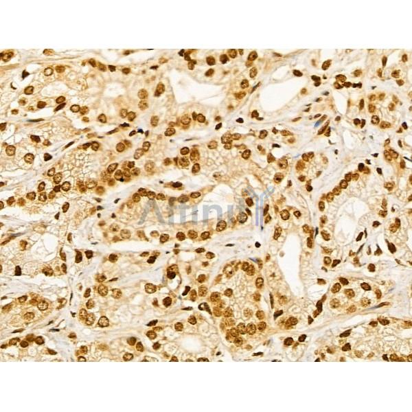 Phospho-SRPK2 (Ser494/Ser497) Antibody - AF3633 at 1/100 staining Human prostate cancer by IHC-P.