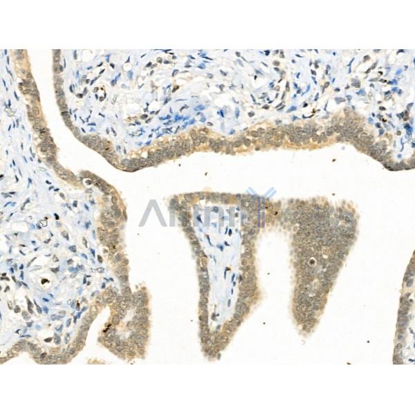 Phospho-YY1 (Ser365) Antibody - AF3694 at 1/100 staining Human ovarian cancer by IHC-P.