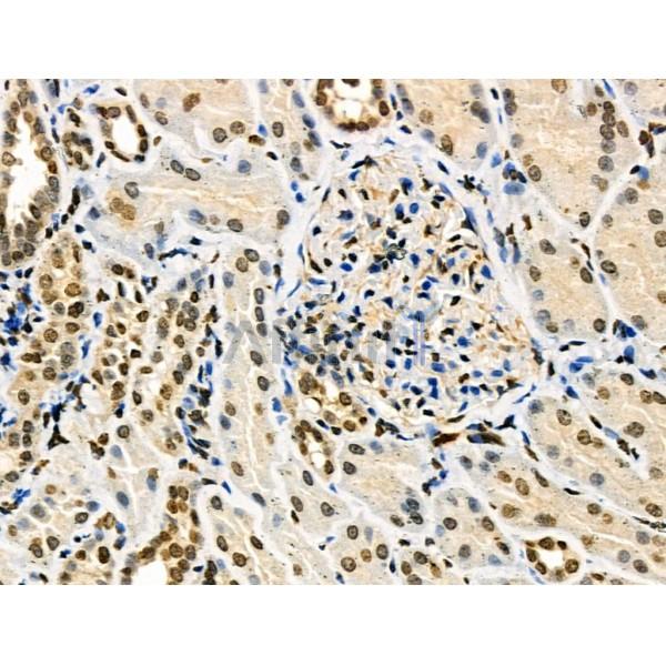 Phospho-TFEB (Ser211) Antibody - AF3708 at 1/100 staining Human kidney cancer and adjacent normal tissues by IHC-P.