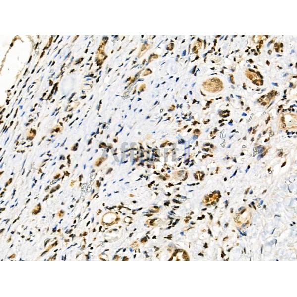Phospho-TFEB (Ser211) Antibody - AF3708 at 1/100 staining Human kidney cancer by IHC-P.