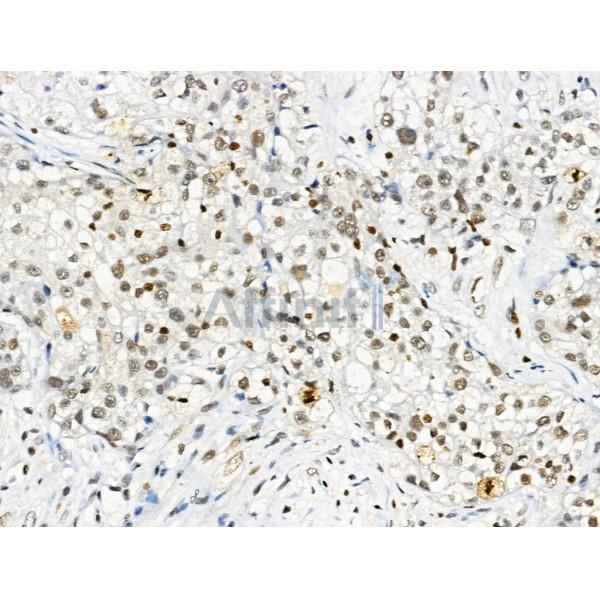 Phospho-Gli2 (Ser149) Antibody - AF3733 at 1/100 staining Human pancreatic cancer by IHC-P.