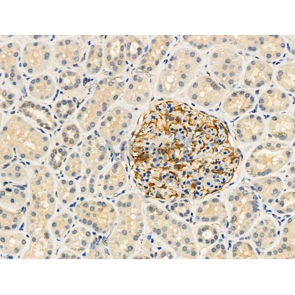 Phospho-Ras-GRF1 (Ser916) Antibody - AF3948 at 1/100 staining Human kidney cancer and adjacent normal tissues by IHC-P.