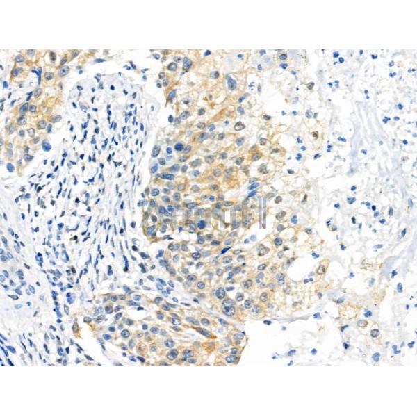 Phospho-PEA15 (Ser104) Antibody - AF3963 at 1/100 staining Human ovarian cancer by IHC-P.