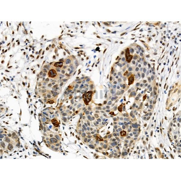 Phospho-TSC1 (Ser505) Antibody - AF4309 at 1/100 staining Human ovarian cancer by IHC-P.