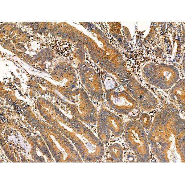 Phospho-NEDD4 (Ser670) Antibody - AF4336 at 1/100 staining Human colorectal cancer and adjacent normal tissues by IHC-P.