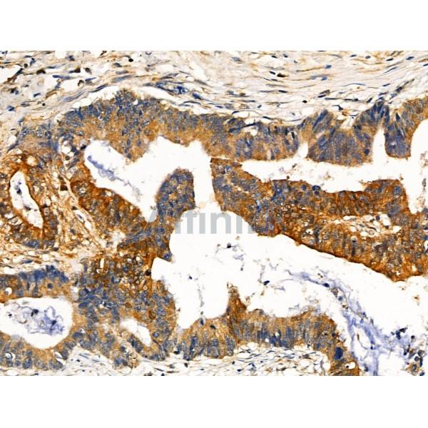 Phospho-NEDD4 (Ser670) Antibody - AF4336 at 1/100 staining Human colorectal cancer by IHC-P.