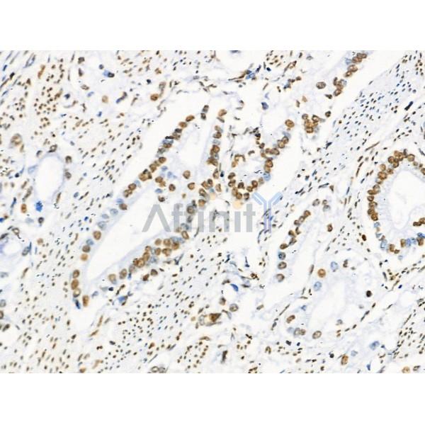 Acetyl-Histone H2A (Lys5) Antibody - AF4354 at 1/100 staining Human gastric cancer by IHC-P.