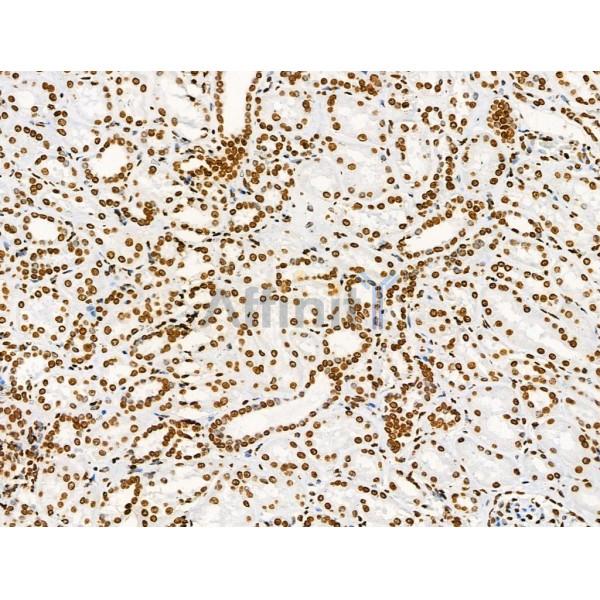 Acetyl-Histone H2A (Lys5) Antibody - AF4354 at 1/100 staining Human kidney cancer by IHC-P.