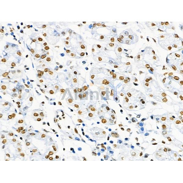 Acetyl-Histone H2A (Lys5) Antibody - AF4354 at 1/100 staining Human gastric cancer and adjacent normal tissues by IHC-P.