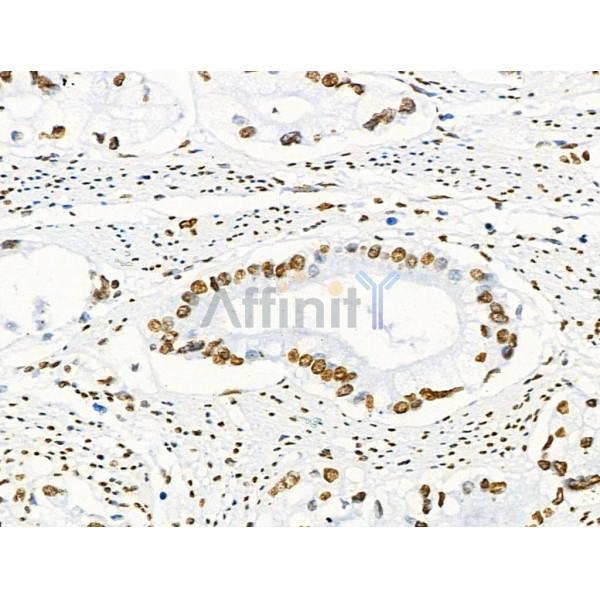 Acetyl-Histone H2A (Lys5) Antibody - AF4354 at 1/100 staining Human gastric cancer by IHC-P.