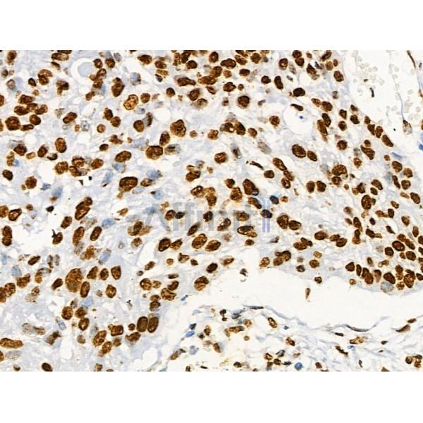 Acetyl-Histone H2A (Lys5) Antibody - AF4354 at 1/100 staining Human colorectal cancer and adjacent normal tissues by IHC-P.