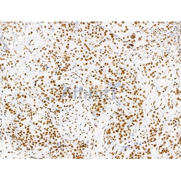 Acetyl-Histone H2A (Lys5) Antibody - AF4354 at 1/100 staining Human pancreatic cancer by IHC-P.