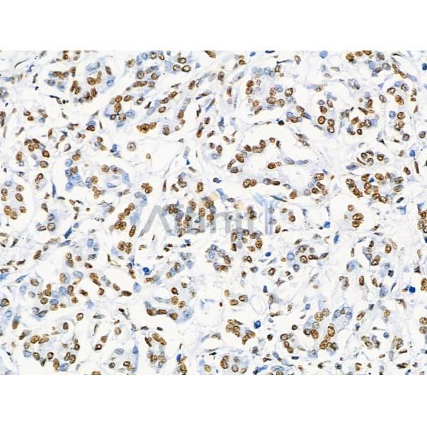 Acetyl-Histone H2A (Lys5) Antibody - AF4354 at 1/100 staining Human pancreatic cancer and adjacent nomal tissues by IHC-P.
