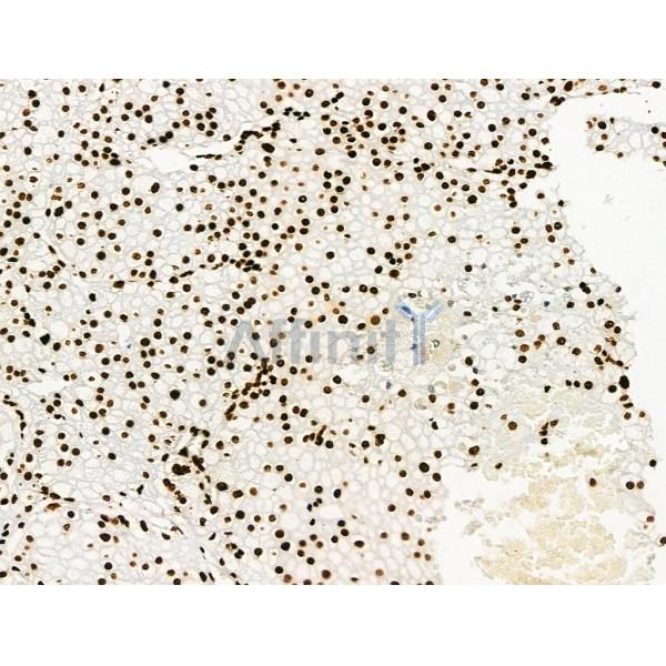 Acetyl-Histone H2A (Lys5) Antibody - AF4354 at 1/100 staining Human ovarian cancer by IHC-P.